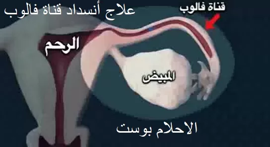 انسداد قناة فالوب