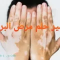 تفسير حلم مرض البرص