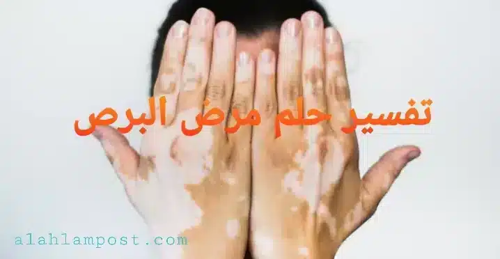 تفسير حلم مرض البرص