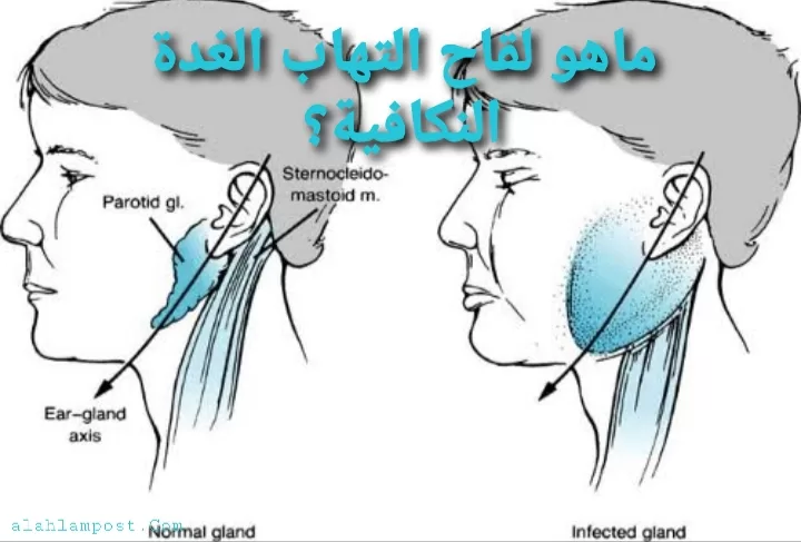 التهاب الغدة النكافية