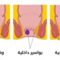 أعراض البواسير