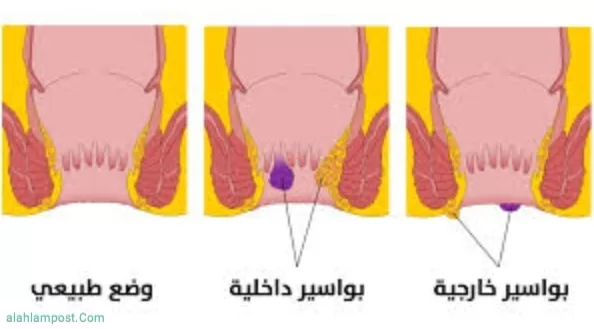 أعراض البواسير